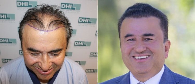 Why is India a Growing Hair Transplant Destination?